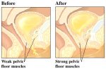 Pelvic Floor Before and After