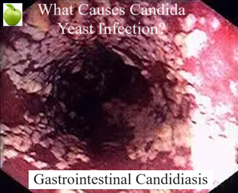 Candida Yeast Infection What causes Candida yeast to overgrow into an infection? Candida is caused by antibiotics, steroids, birth control, sugar and refined carbohydrates.