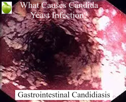 Candida Yeast Infection What causes Candida yeast to overgrow into an infection? Candida is caused by antibiotics, steroids, birth control, sugar and refined carbohydrates. This includes any processed food, prepackaged food and fast food, all are unnatural and should be avoided.