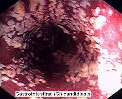 Candida Yeast Infection in the Gut.