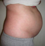 Image of Extreme Bloating