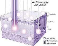 DPL Wavelengths Penetrate Deep Producing Collagen and Elastin For Smoother Younger Looking Skin.