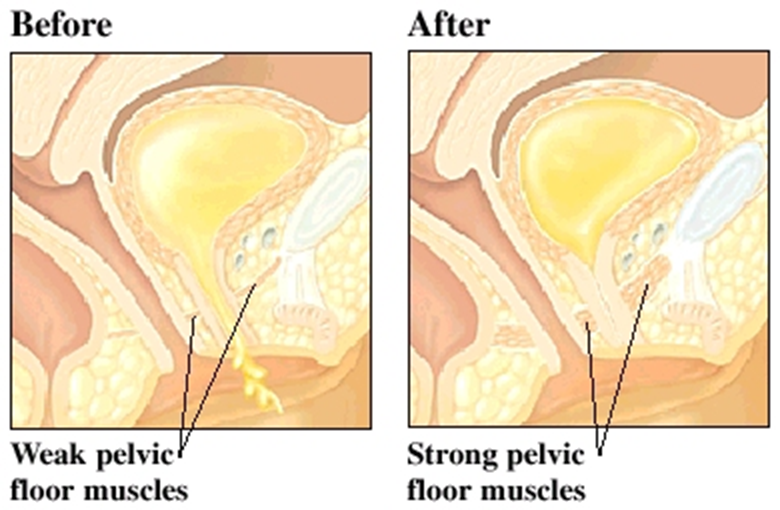 Picture of a strong pelvic floor compared to a weak pelvic floor that allows pee to escape.