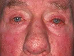 This sub-type of Rosacea causes the eyes and eyelids to become red and bloodshot. It also can cause burning or stinging, itching, dryness, light sensitivity, blurred vision or visible blood vessels.