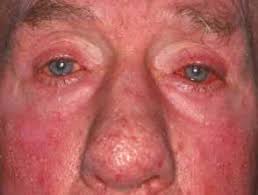 This sub-type of Rosacea causes the eyes and eyelids to become red and bloodshot. It also can cause burning or stinging, itching, dryness, light sensitivity, blurred vision or visible blood vessels.