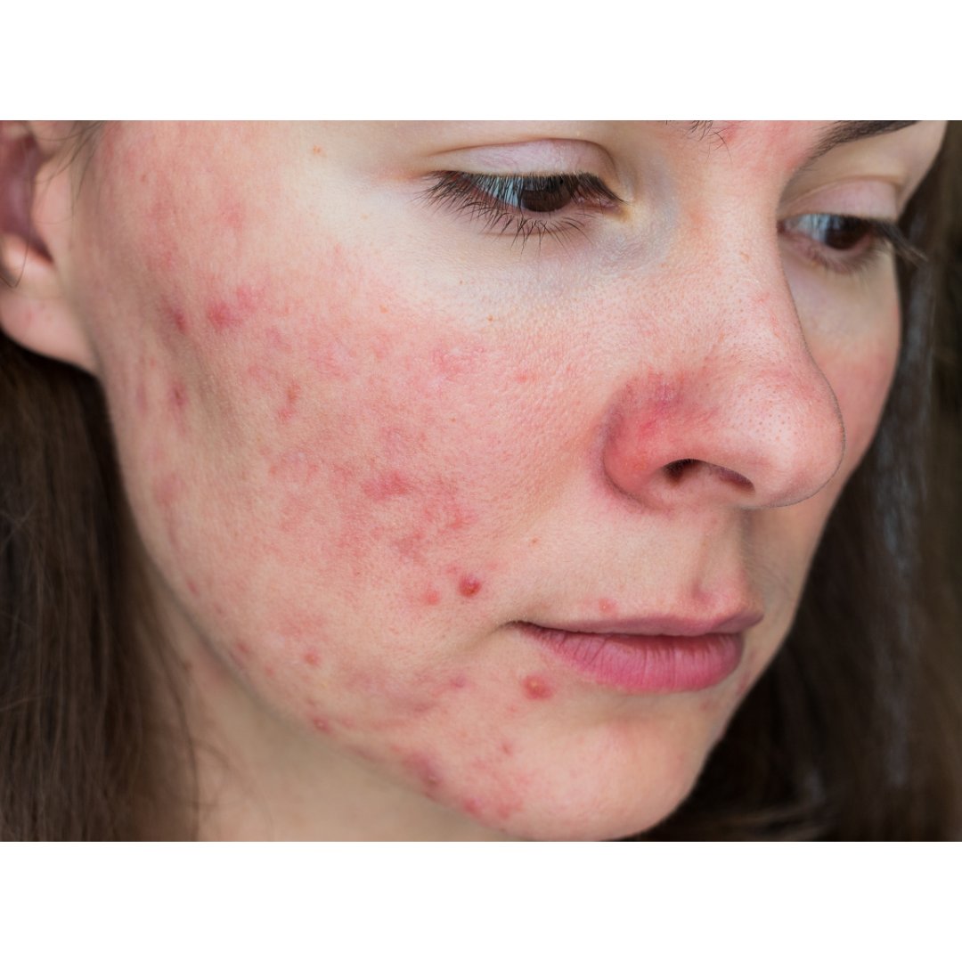 This type of Rosacea causes bumps and blemishes on your face that looks like acne and the most commonly treated type of Rosacea.