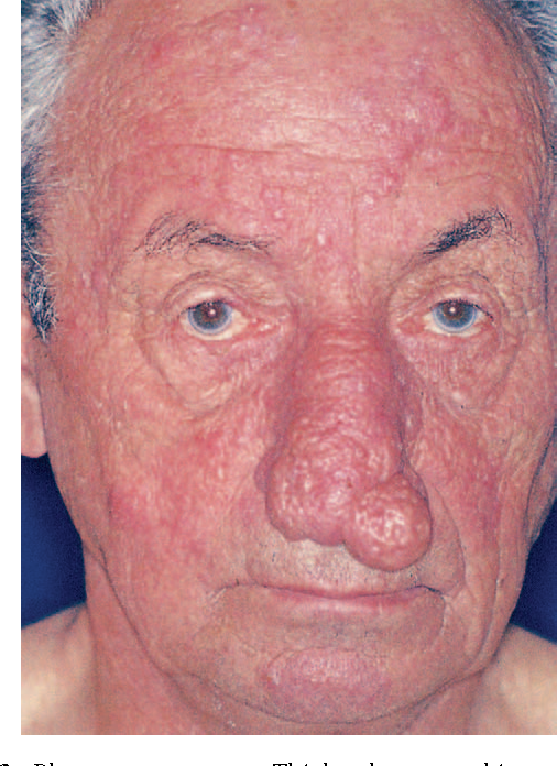 This sub-type of Rosacea that thickens the skin. It usually appears around the nose and is more common in men. Without early treatment, small knobby bumps can form making the nose look larger.