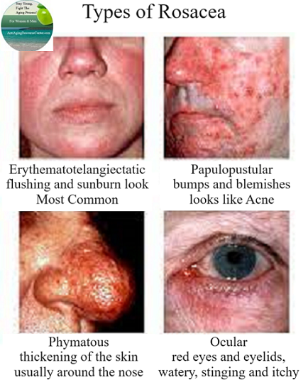 Sub-Types of Rosacea, understanding the different skin conditions. Getting a better understanding about the sub-types of Rosacea, will help assist you manage it and its flare ups.